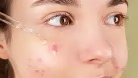 Akne İzleri İçin Peeling