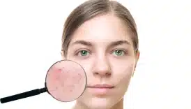 Sivilce Siyah Nokta Karşıtı Serum