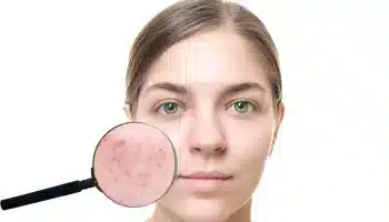 Sivilce Siyah Nokta Karşıtı Serum